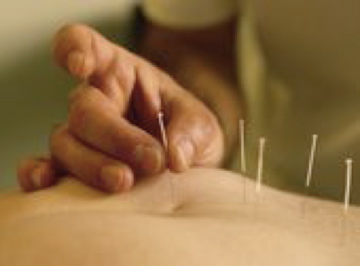Acupuncture